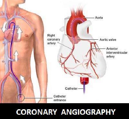 Coronair angiogram